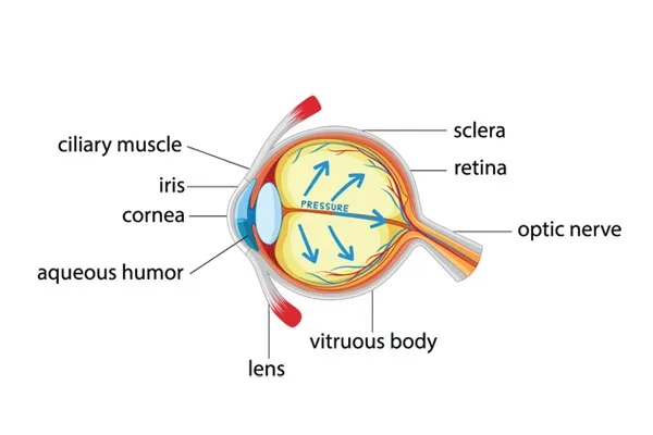 Eye with glaucoma