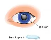 Eye with a cataract