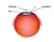 Removal of the diseased lens