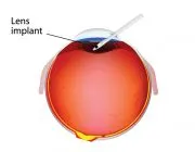 Implantation of the lens
