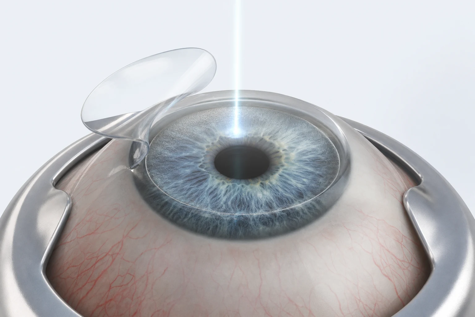 Creating the flap with a femtosecond laser