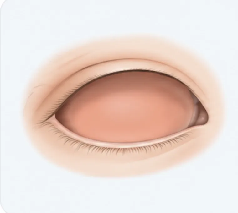 Socket without the globe (after enucleation)