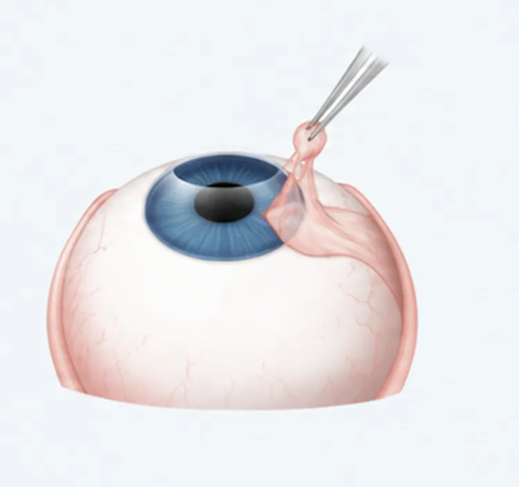Removal of the pterygium