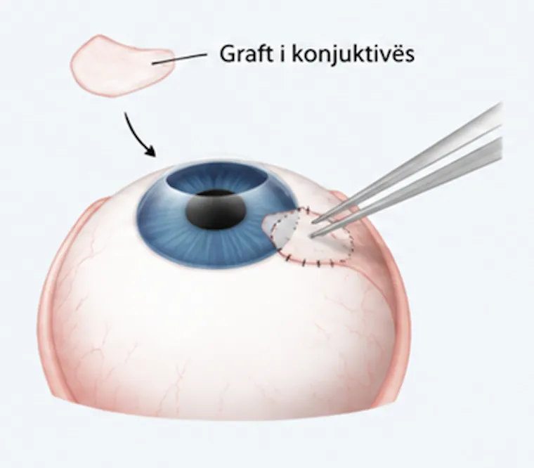 Placement of the conjunctival graft
