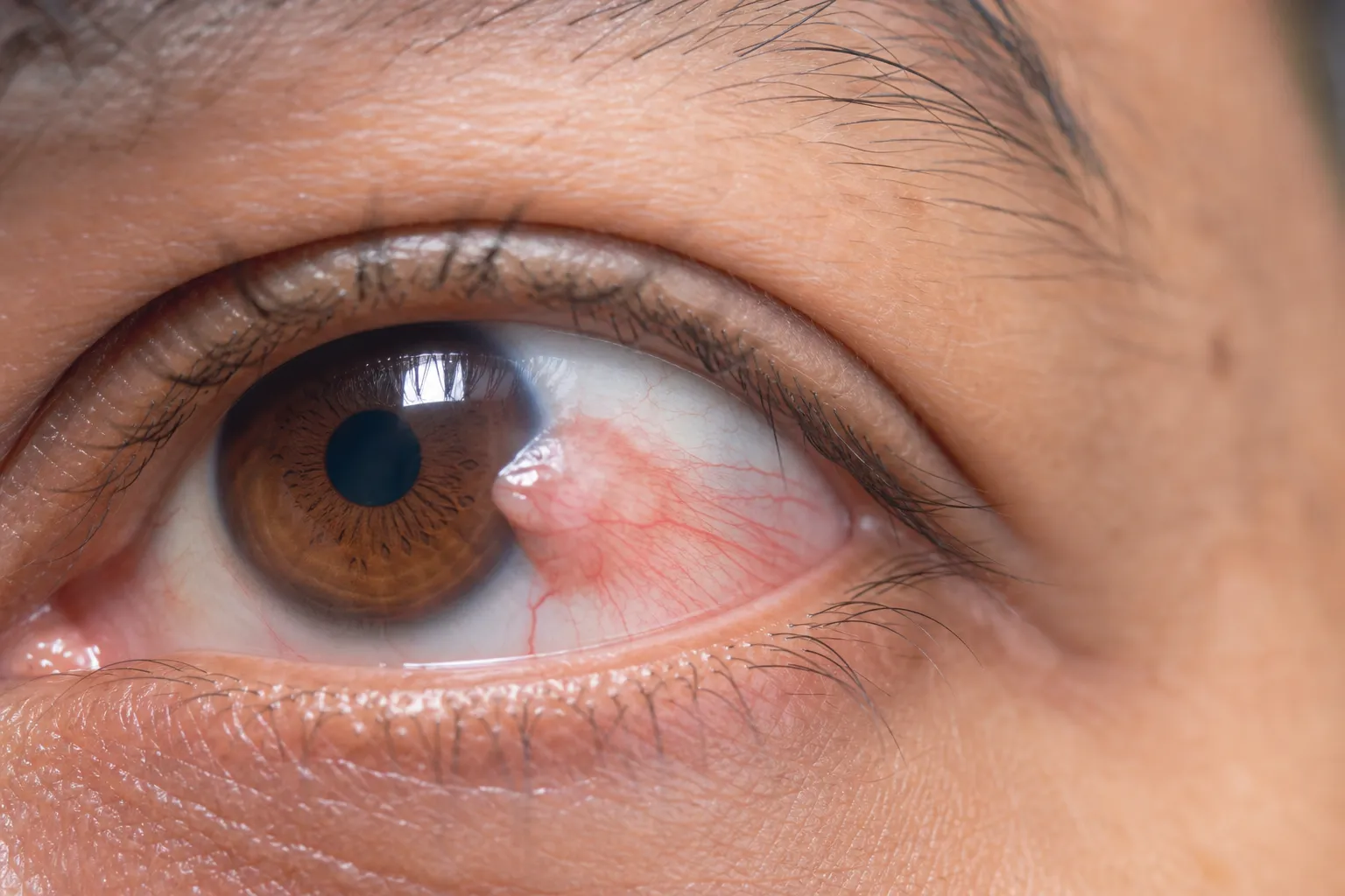 Pterygium (Surfer's Eye)